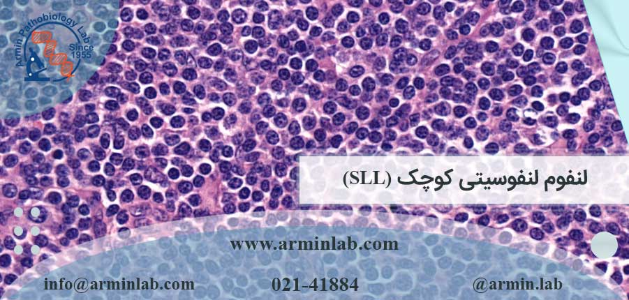 لنفوم لنفوسیتی کوچک (SLL)