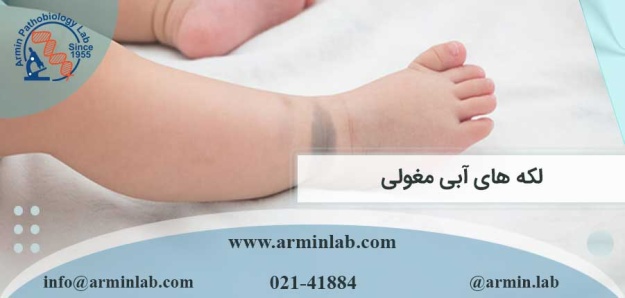 لکه-های-آبی-مغولی-arminlab لکه های آبی مغولی