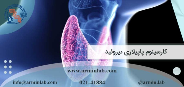 کارسینوم پاپیلاری تیروئید