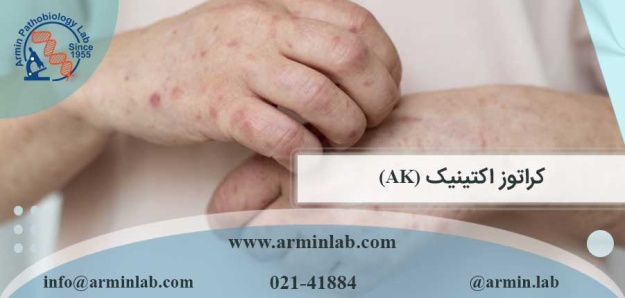 کراتوز اکتینیک (AK)