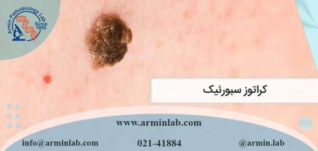 کراتوز سبورئیک