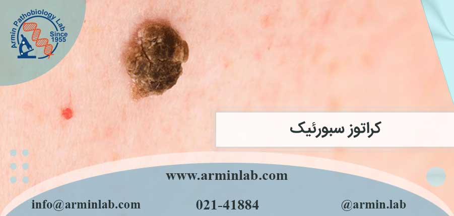 کراتوز سبورئیک