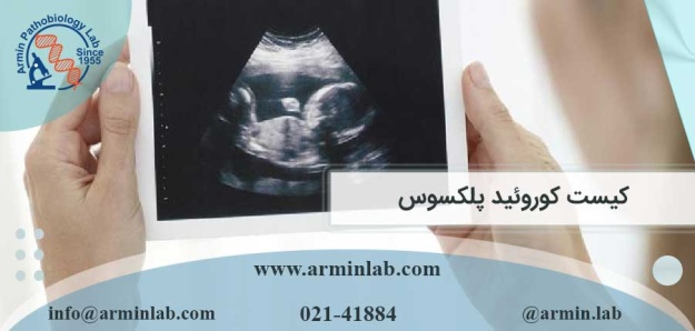 کیست کوروئید پلکسوس