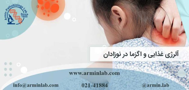 آلرژی غذایی و اگزما در نوزادان