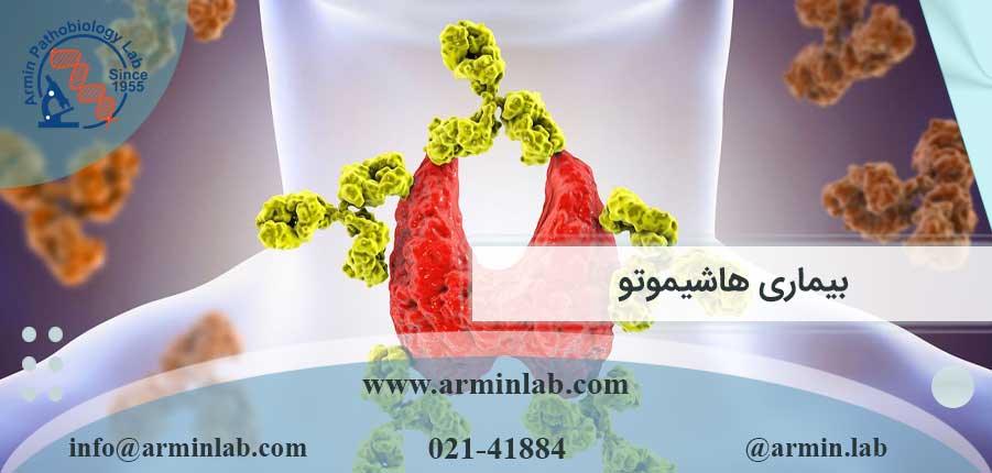 بیماری هاشیموتو
