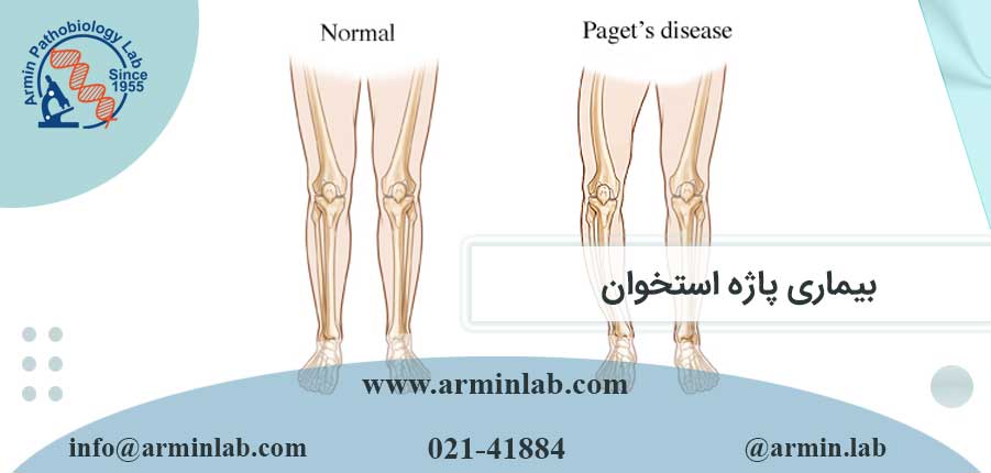 بیماری پاژه استخوان
