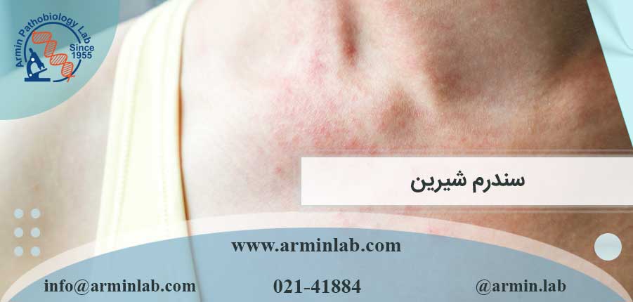 سندرم شیرین