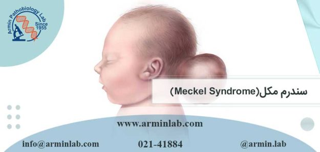 سندرم مکل (Meckel Syndrome)
