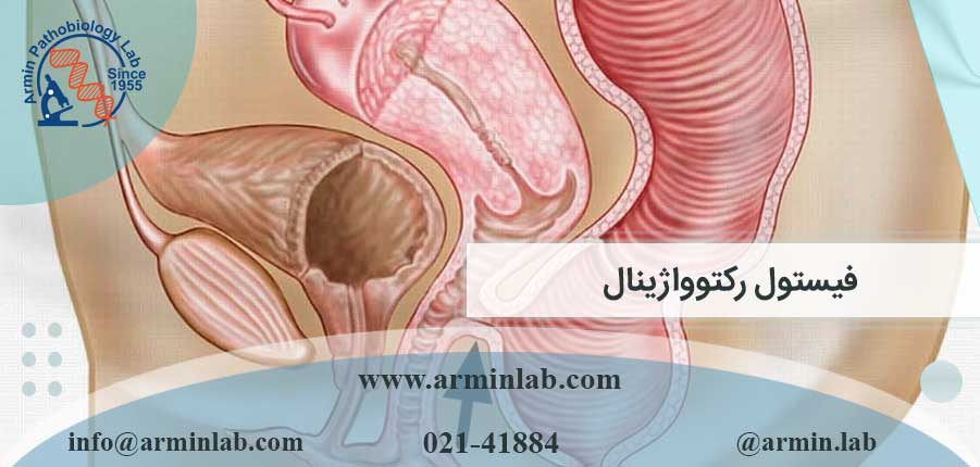 فیستول رکتوواژینال