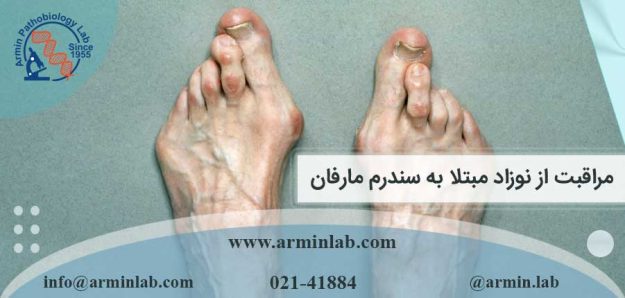 مراقبت از نوزاد مبتلا به سندرم مارفان