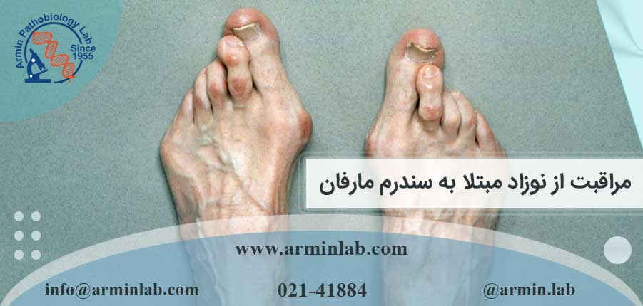 مراقبت از نوزاد مبتلا به سندرم مارفان