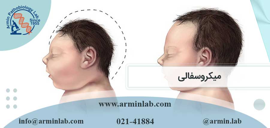 میکروسفالی-arminlab میکروسفالی
