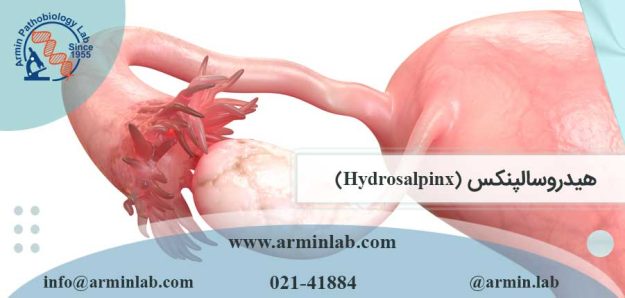 هیدروسالپنکس (Hydrosalpinx)