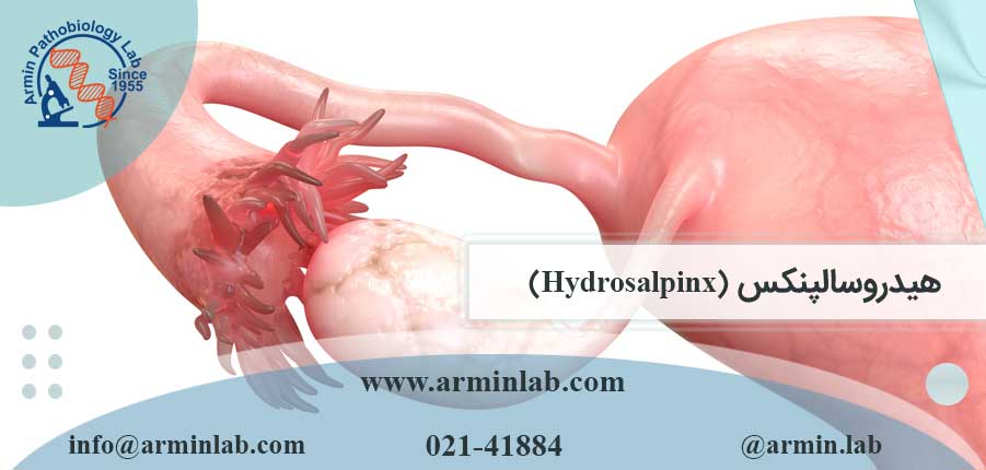 هیدروسالپنکس (Hydrosalpinx)