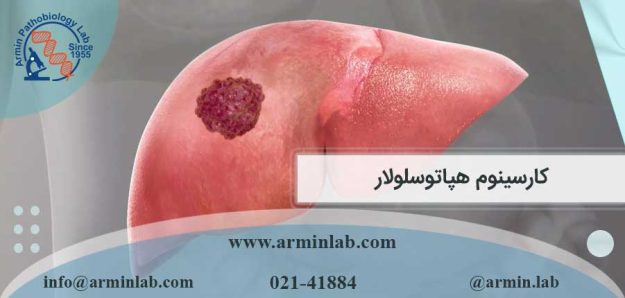 کارسینوم هپاتوسلولار