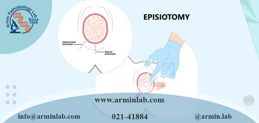 اپیزیوتومی