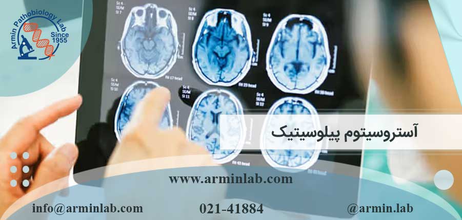 آستروسیتوم پیلوسیتیک