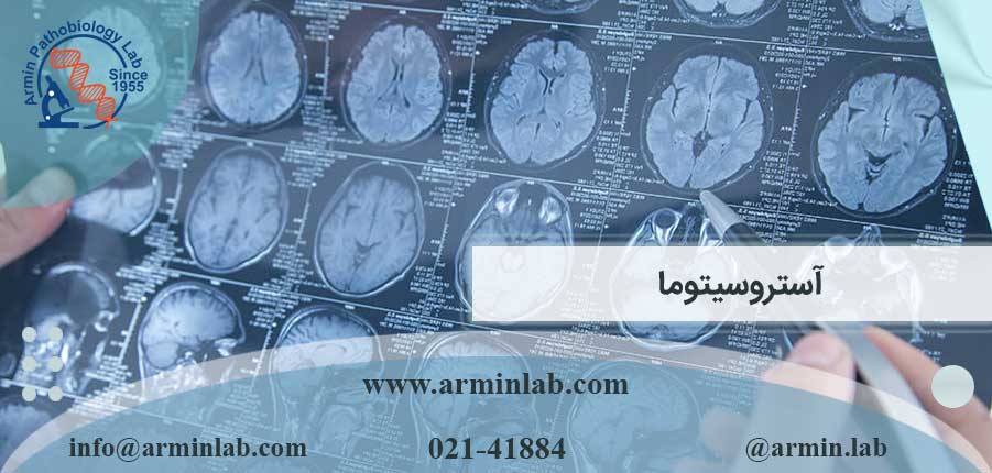 آستروسیتوما