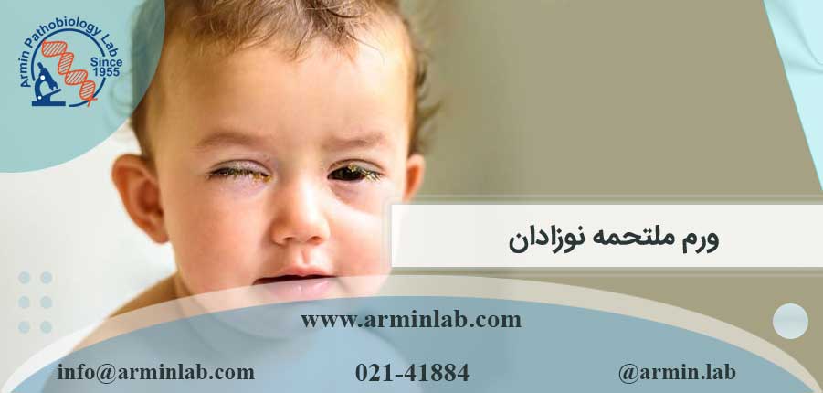 ورم ملتحمه نوزادان