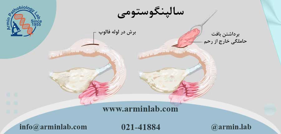  سالپنگوستومی