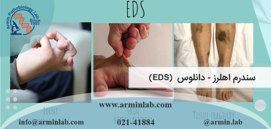 سندرم اهلرز دانلوس