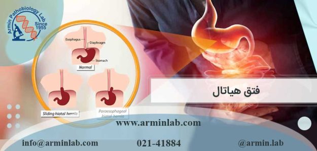 فتق هیاتال