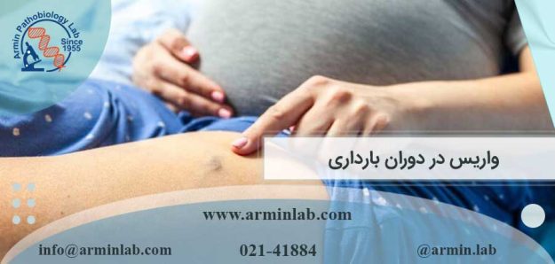 واریس در دوران بارداری