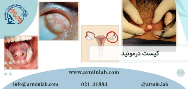 کیست درموئید