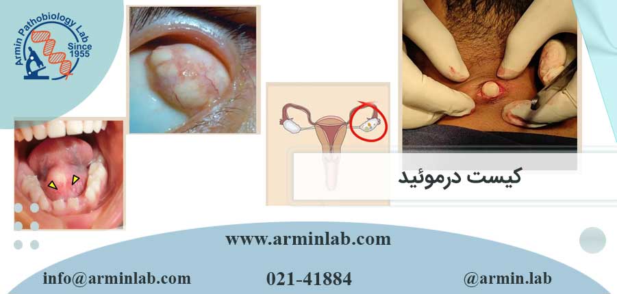 کیست درموئید