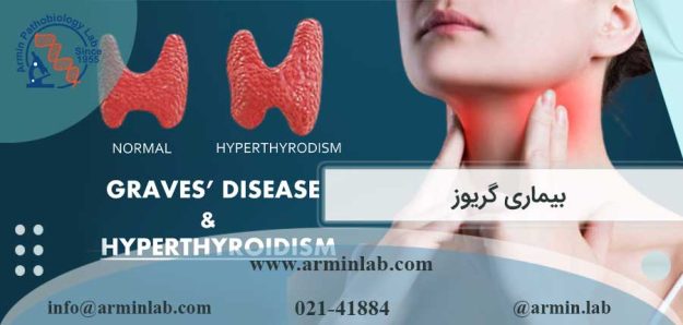 بیماری گریوز