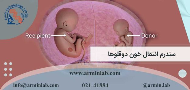 سندرم انتقال خون دوقلوها