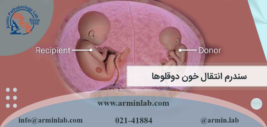 سندرم انتقال خون دوقلوها