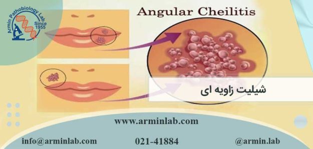 شیلیت زاویه ای