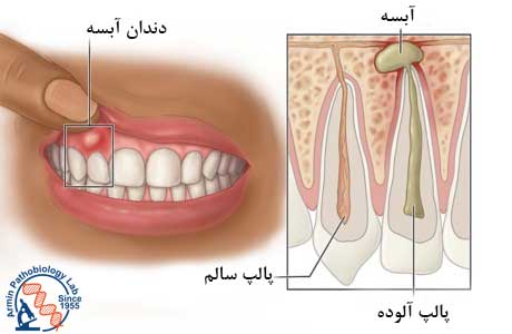 آبسه دندان 