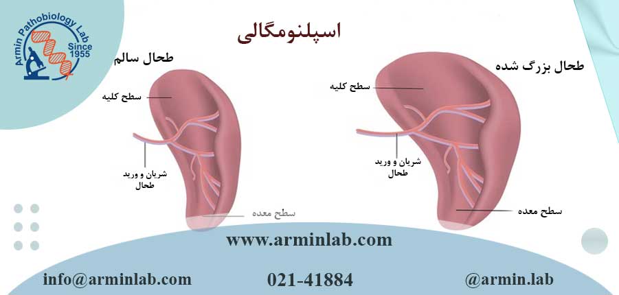 اسپلنومگالی (طحال بزرگ شده)