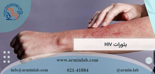 بثورات HIV