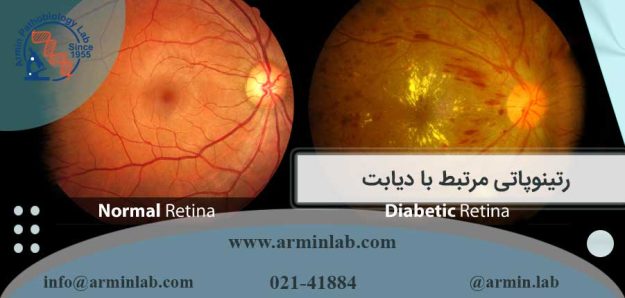 رتینوپاتی مرتبط با دیابت