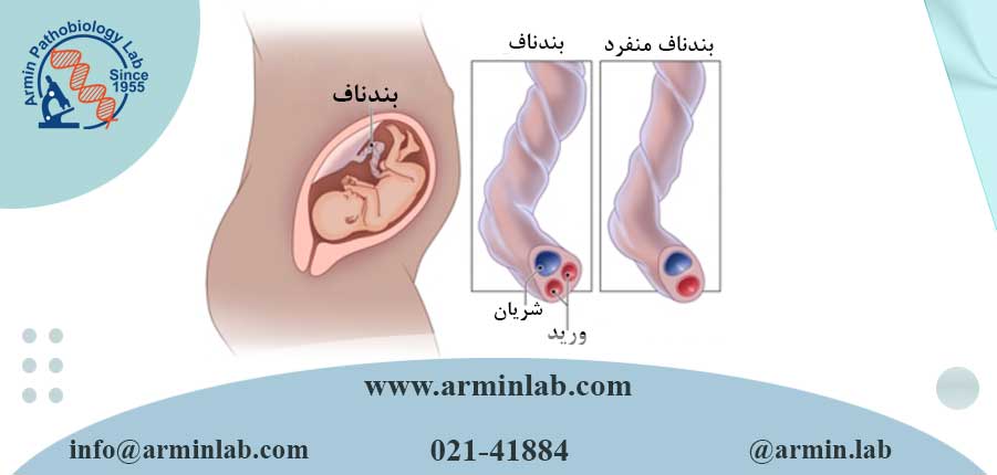 شریان نافی منفرد در بارداری 