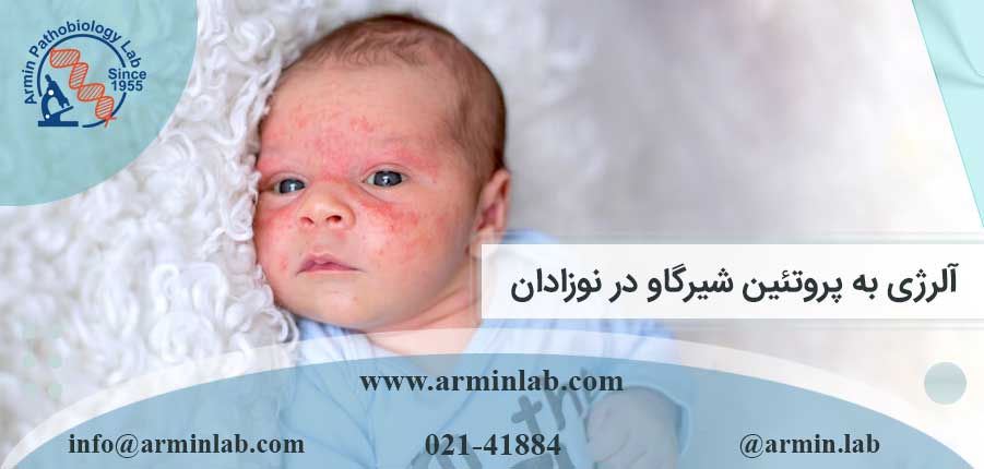 آلرژی به پروتئین شیرگاو در نوزادان