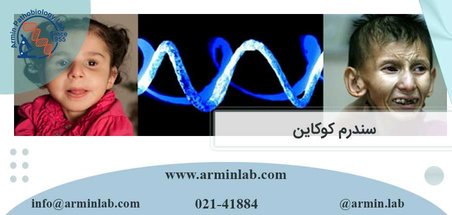 سندرم کوکاین