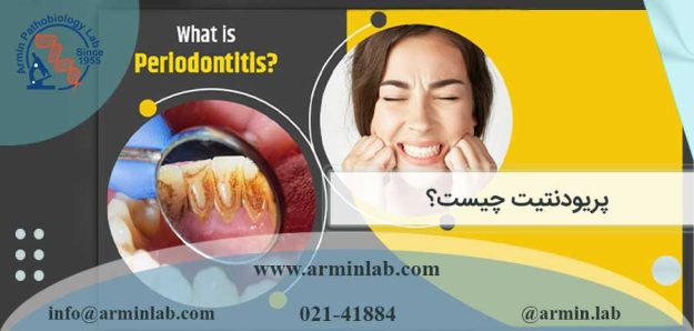 پریودنتیت چیست؟