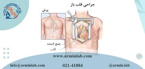 جراحی قلب باز 