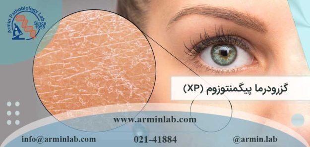 گزرودرما پیگمنتوزوم