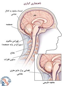 ناهنجاری آرنولد کیاری