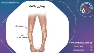 بیماری بلانت