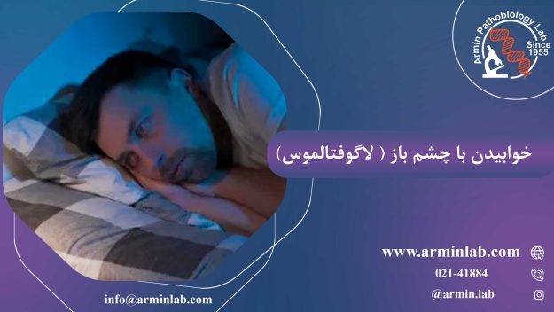 خوابیدن با چشم باز(لاگوفتالموس)