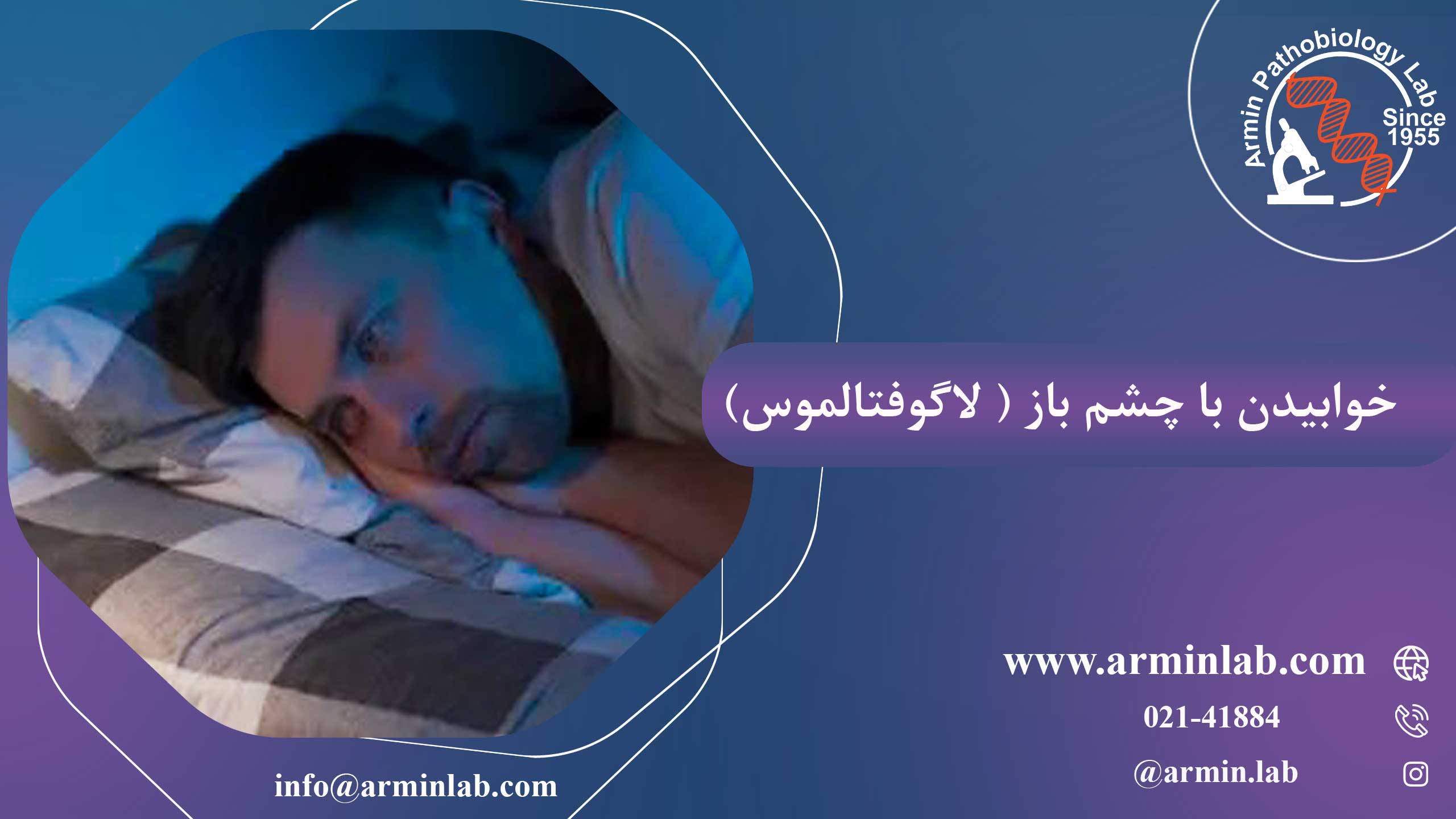 خوابیدن با چشم باز(لاگوفتالموس)