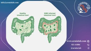   رشد بیش ازحد باکتری‌های روده کوچک(SIBO)