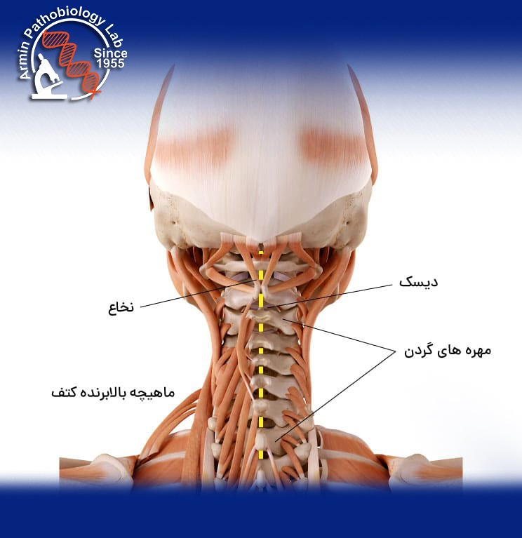 اسپاسم گردن