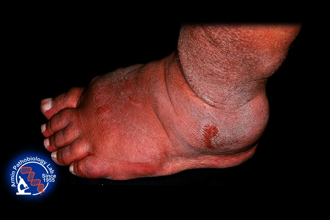 بثورات میگزدم(Myxedema) 